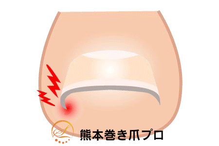 巻き爪矯正の図